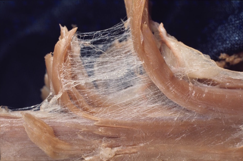 The flesh-coloured, curved strands are muscle fibres that have be split apart from each other and the whitish material between the muscle is the fascia that has also been pulled apart.